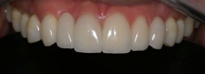 Crown lengthening, Gum lift, a new crown and Porcelain Veneers