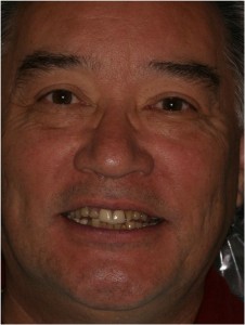 Full mouth reconstruction, Porcelain Veneers, Porcelain Crowns, Dental Implants