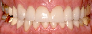 smile after giving a patient stronger teeth with veneers and crowns