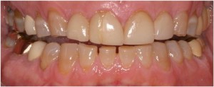 broke and cracked old veneers and crowns