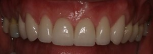 Porcelain Veneers to improve old dental bonding