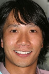 Porcelain Veneers to improve old dental bonding