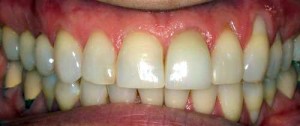 female porcelain veneers patient after gum disease treatment