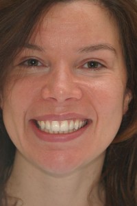 before photo of patient after new Dental crowns