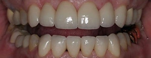 patient of Dr. Rice after All-on-4 dentures
