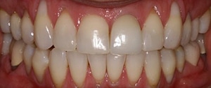 female porcelain veneers patient before gum disease treatment