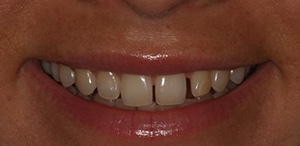 female patient of Dr. Rice in need of Porcelain veneers