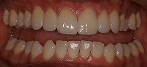 very natural appearance with dental veneers