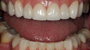Cosmetic Crown lengthening and Porcelain Veneers