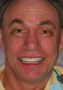 Treatment was Full Mouth Reconstruction in just a few visits