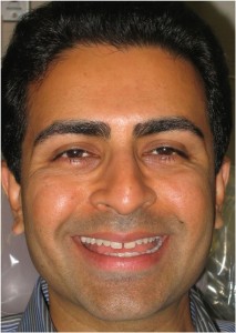 before closing the space in front of teeth
