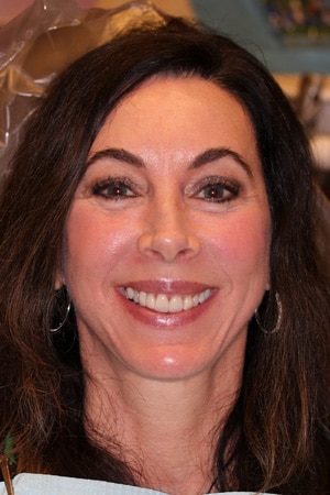 Jenni-Before Before smile of a patient seeking dental veneers